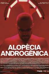 Androgenic Alopecia